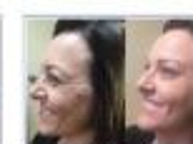 Botox for Face