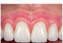 Crown Lengthening