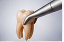 Tooth Extraction