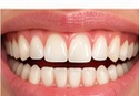 Full Mouth Rehabilitation