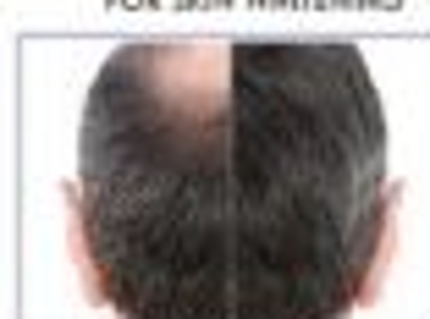 Hair Transplant