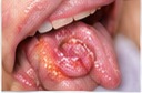 Oral Cancer Rehabilitation