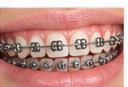 Orthodontic Treatment