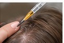 PRP for Hair Growth