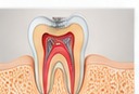 Root Canal Treatment